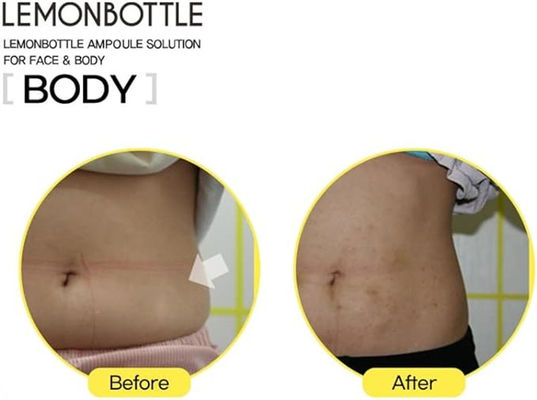 Korea Fat Solution Lemon Flasje 10ml*5 Vetoplosmiddel Online Verkoop